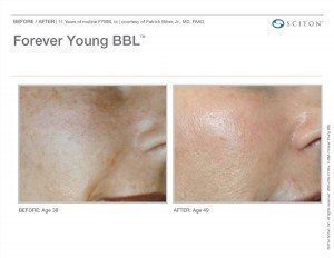 Before and after of woman's cheek for Forever Young BBL treatment