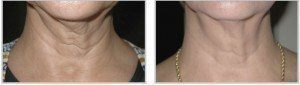 Before and after of a woman's neck skintyte treatment