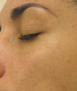 Hyperpigmentation after Hydrafacial