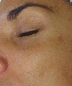Hyperpigmentation before