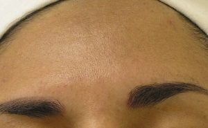 After four treatments