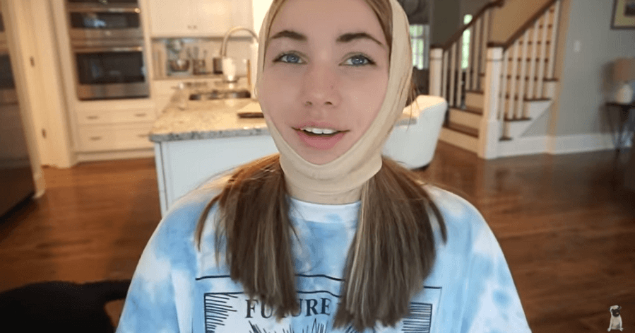 Stepanka 3 weeks after chin liposuction